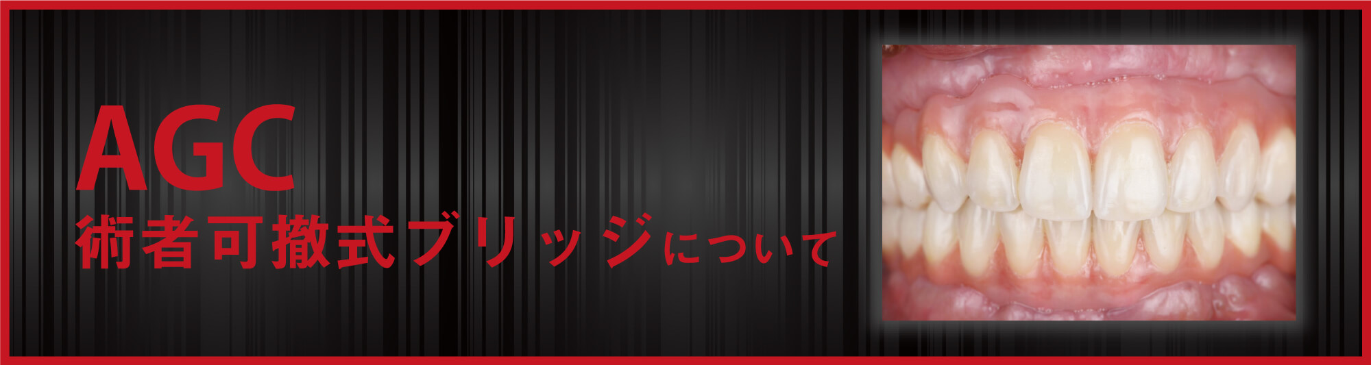 AGC術者可撤式ブリッジ