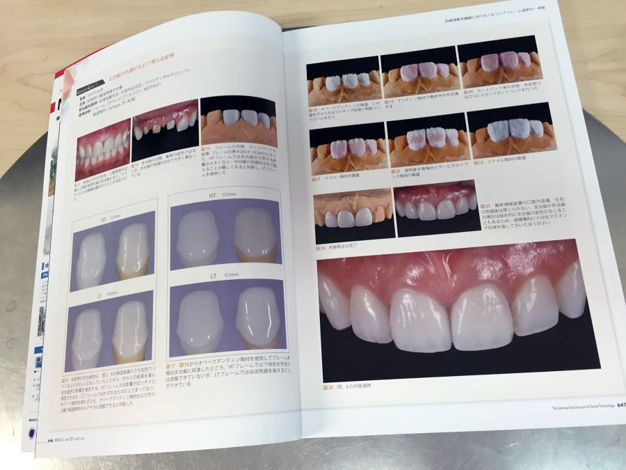 201506_ラザロ_月刊歯科技工.jpg